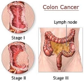 Prevención del cáncer de colón