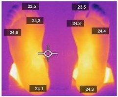 El investigador Álvaro Astasio recomienda la valoración neurovascular del pie como exploración complementaria al examen clínico.