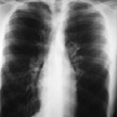 El Marañón analiza la incidencia de embolia pulmonar por factores medioambientales