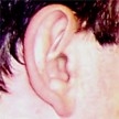 La otitis de la piscina, principales motivos de consultas en las Urgencias pediátricas