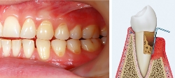 La gingivitis