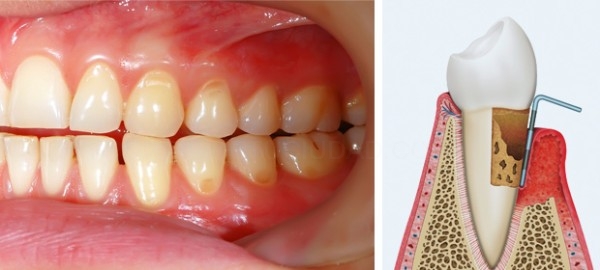 La gingivitis