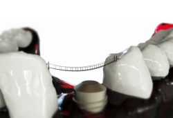 ¿CUÁL ES EL IMPLANTE DENTAL PARA MI TRATAMIENTO?