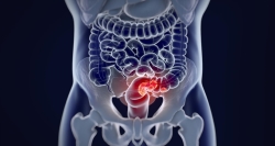 Probamos la eficacia del ayuno de corta duración en enfermos de cáncer colorrectal