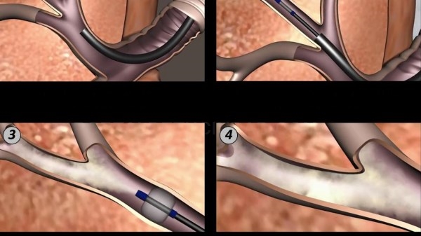 La Sección de Broncoscopia y Función Pulmonar implanta una técnica pionera para tratar el enfisema pulmonar severo.