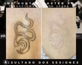 Eliminación de Tatuajes Valladolid - Ink Suckers