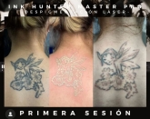 Eliminación de Tatuajes Valladolid - Ink Suckers
