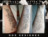 Eliminación de Tatuajes Valladolid - Ink Suckers