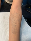 Eliminación de Tatuajes Valladolid - Ink Suckers