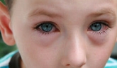 Conjuntivitis: no son lágrimas de cocodrilo