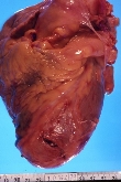 Claves para predecir la rotura cardiaca