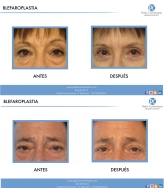 La cirugía estética es cada vez más frecuente en las personas mayores de 50 años