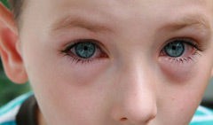 Conjuntivitis: no son lágrimas de cocodrilo