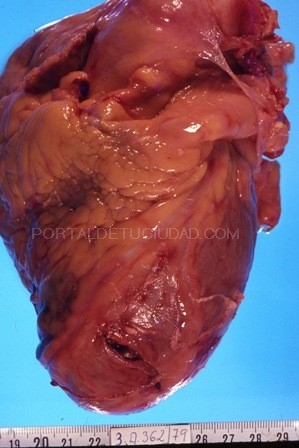 Claves para predecir la rotura cardiaca