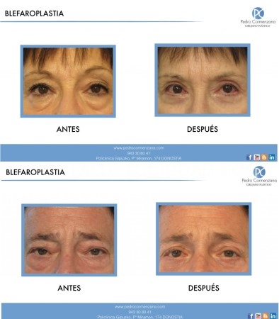 La cirugía estética es cada vez más frecuente en las personas mayores de 50 años