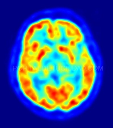 José Ángel Obeso: Luchamos para convertir el párkinson en una enfermedad crónica