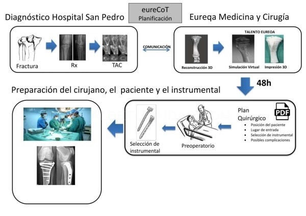El complejo hospitalario universitario de Cáceres utiliza impresión 3D para replicar huesos y operar fracturas.