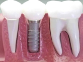 DENTISTA EN CORUÑA. IMPLANTES EN CORUÑA. CUBELA EN CORUÑA. CLÍNICA DENTAL EN CORUÑA. ODONTOLOGÍA COR